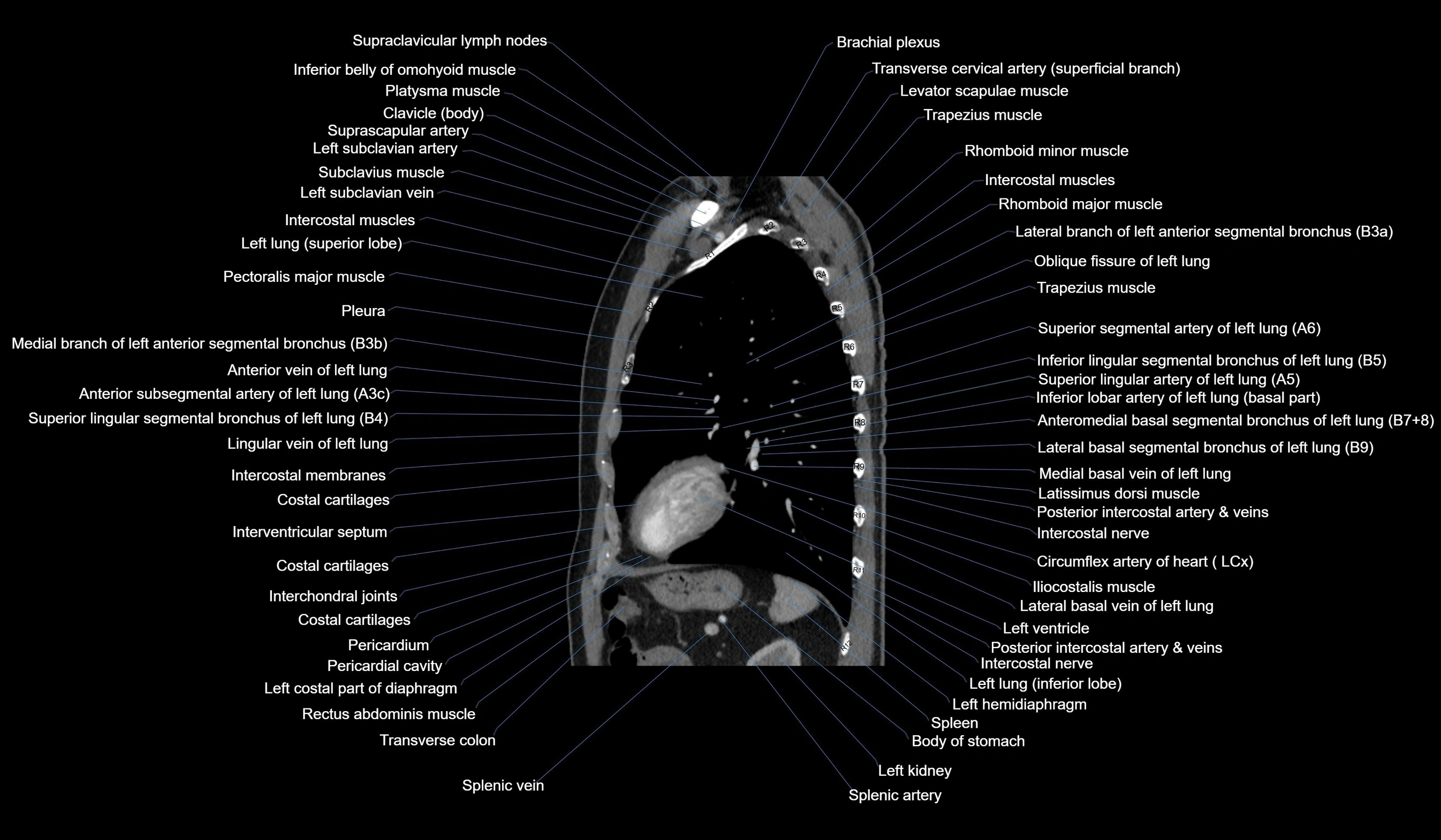 CT chest (thorax) soft tissue window labelled sagittal cross sectional anatomy radiology image-00099.webp